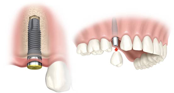 un implant dentar